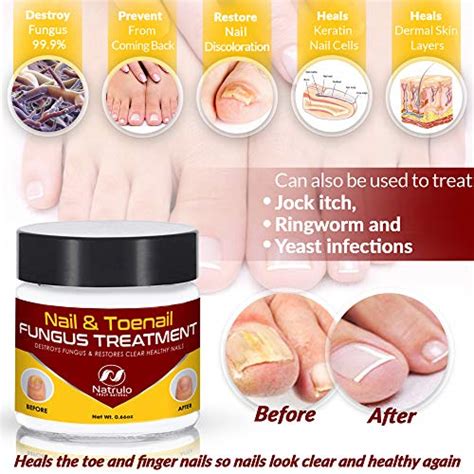 Nail And Toenail Fungus Treatment Herbal Anti Fungal Cream With