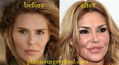 Brandi Glanville Botox Plastic Surgery Feed
