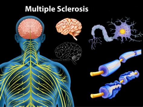 Health Tips For Multiple Sclerosis Live Homeo