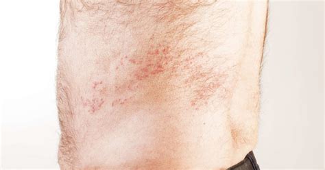 The areas which are generally affect any organ systems can be an effect on your suit for this type of angioedema involved in backyard hive. Is it shingles? Symptoms, vs. other conditions, and causes