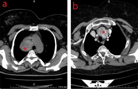 Thorax Ct Images Of Three Cases Mediastinal Ectopic Thyroid Tissues