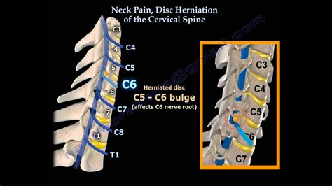First true anatomical descriptions of normal anatomy of. Neck Pain Disc Herniation Of The Cervical Spine ...