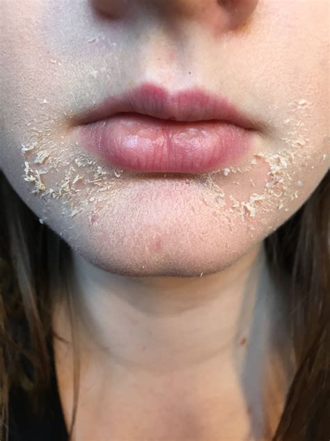 Unmissable offers on selected face masks & coverings. Please help me! Extremely dry flakey skin from retin-a ...