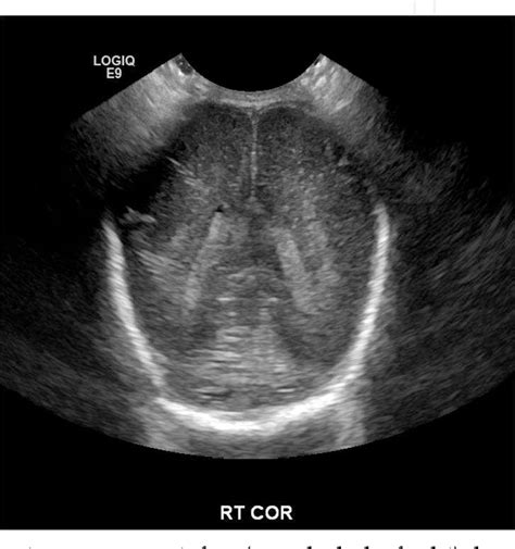 Cranial Ultrasound