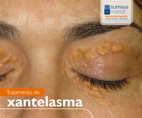 O xantelasma é uma lesão plana ou levemente elevada amarelada ou esbranquiçada localizada nas