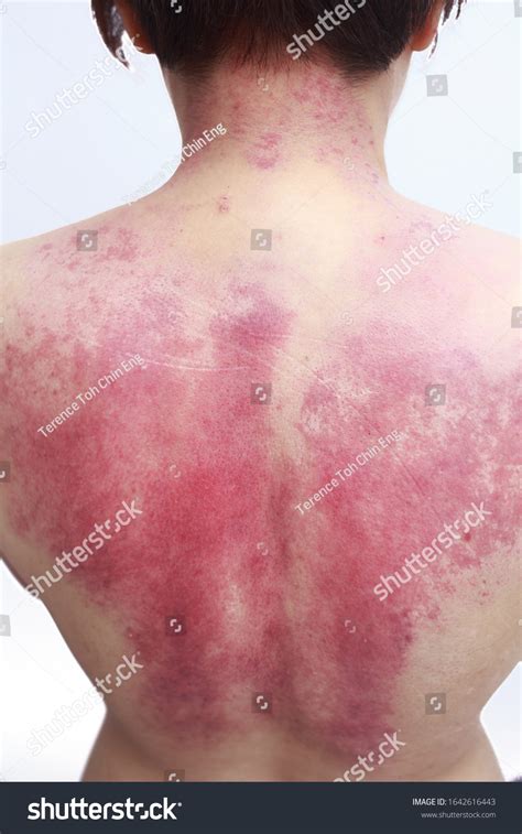 Red Rashes On Back Adult Woman Stock Photo 1642616443 Shutterstock