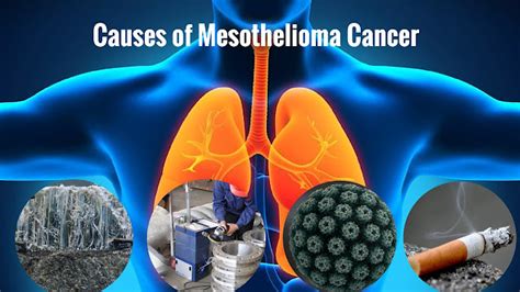 Mesothelioma What Is Mesothelioma Cancer Symptoms And Causes