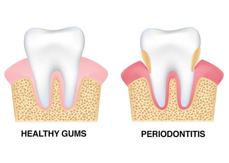 Birmingham Al Periodontal Disease And Tooth Loss Gum Recession