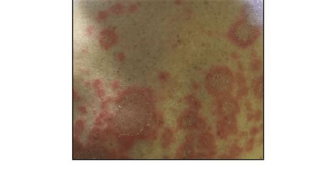 Papulosquamous Rash Of Back Consistent With Subacute Lupus