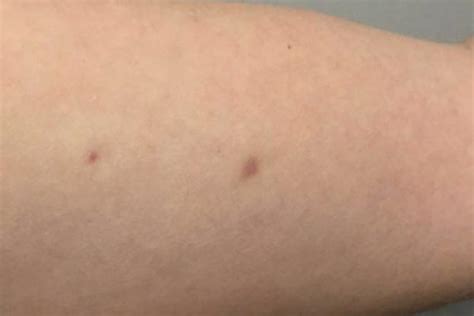 Purple Dots On Arm