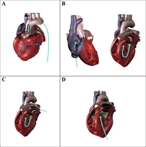 Transcatheter Valve Repair And Replacement Thoracic Key