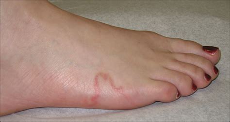 An Unusual Presentation Of Cutaneous Larva Migrans Dermatology Jama