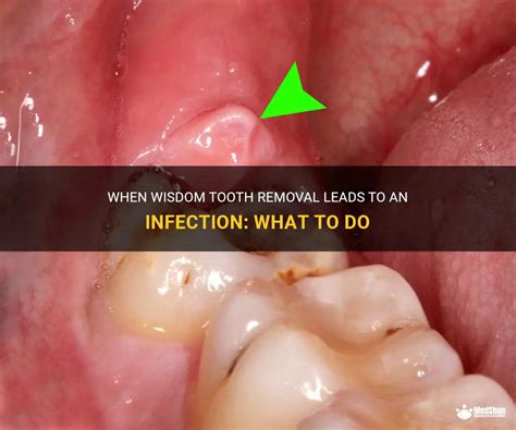 When Wisdom Tooth Removal Leads To An Infection What To Do Medshun