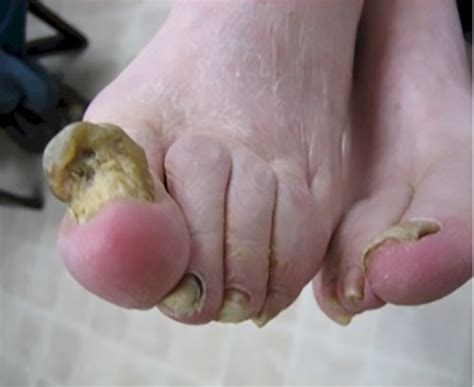 Onychomycosis | Causes and treatment options - Printer friendly version