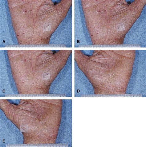 Treatment Of Palmoplantar Psoriasis With Intramuscular Alefacept