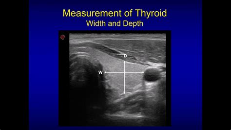 Graves' disease, an autoimmune disorder that causes hyperthyroidism, can lead to problems with the heart, bones, muscles ultrasound, which can reveal whether the thyroid gland is enlarged. Neck ultrasonography | Thyroid ultrasound, Ultrasound, Thyroid