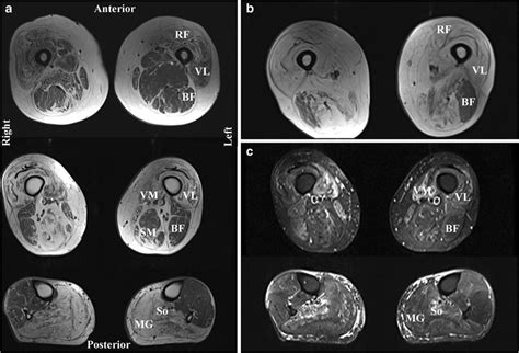 Ongoing Developments In Sporadic Inclusion Body Myositis Springerlink