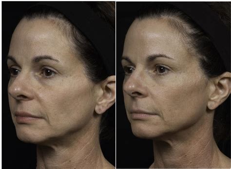 Thermage Before And After Photos Patient 29 Houston Tx Dermsurgery