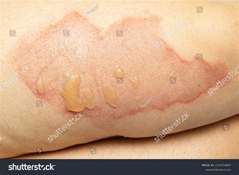 Close Leg Terrible Burn Injury After Stock Photo Shutterstock