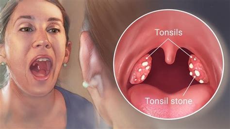Tonsil Stones Can Be A Manifestation Of Dairy Sensitivity The Healthy