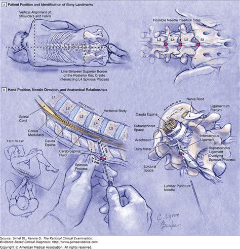 Lumbar Puncture Anatomy Anatomy Diagram Book