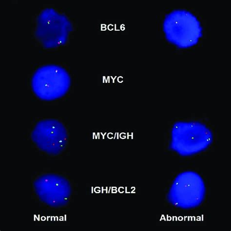 Low Grade Follicular Lymphoma Transforming Into Diffuse Large B Cell