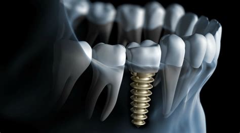 What Is Osteointegration Of Dental Implants Upland Dental Group And