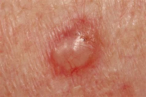 Hard Pimple That Wont Go Away After 2 Months May Be Cancer Scary