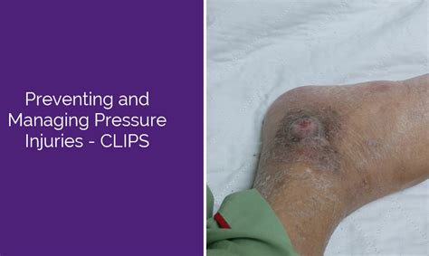Preventing And Managing Pressure Injuries — Healthcare Australia Online