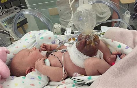 Girl Born “inside Out” Has Life Saving Surgery Minutes After Birth Her