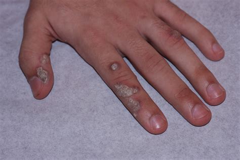 Check spelling or type a new query. Wart Removal for Children - Wart Removal Treatments