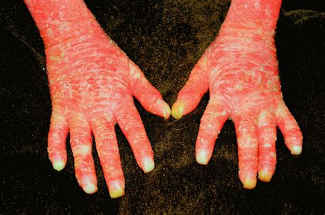Ichthyosis With Confetti A Rare Diagnosis And Treatment Plan Bmj