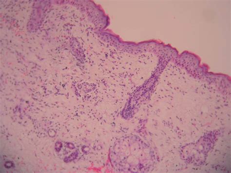 Lupus Eritematoso Neonatal 4 Casos Y Revisión Clínica Actas Dermo