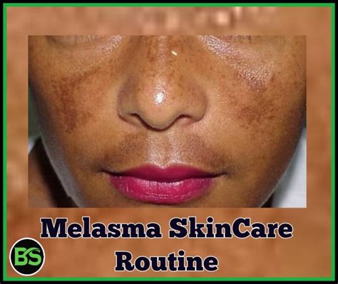 Best Melasma Treatment The Complete Guide To Get Rid Of Melasma