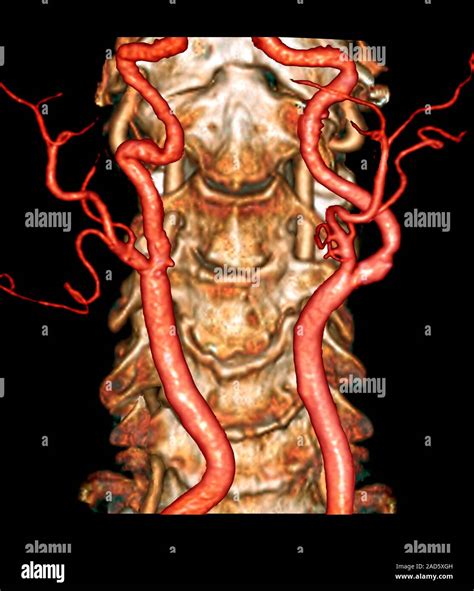 Carotid Artery Disease Coloured 3d Computed Tomography Ct Scan And