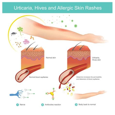 10 Frequently Asked Questions About Acute Urticaria Facty Health