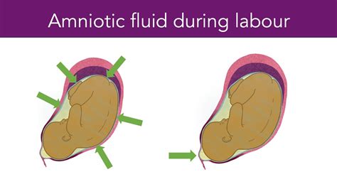 Amniotic Fluid During Labour Youtube