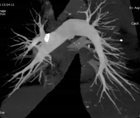 Pulmonary Angiography Beautiful 128 Slice Ct Images Sumers