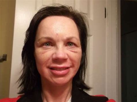Prednisone Swelling Face Facial Swelling Caused By Prednisone