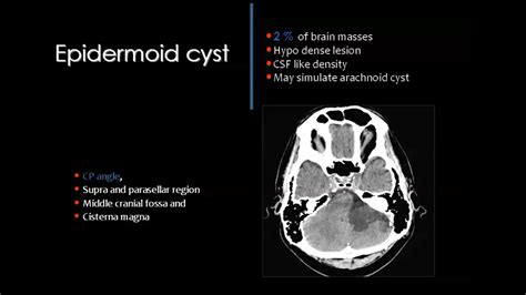 Epidermoid Cyst Brain