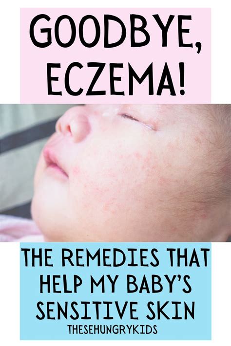 How To Treat Eczema Rash On Babies Images And Photos Finder