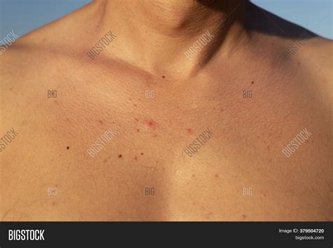 Red Acne Rash Chest Image And Photo Free Trial Bigstock