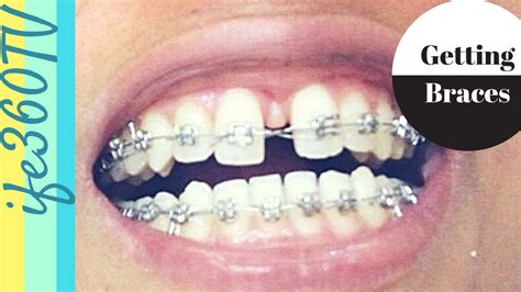 Understanding the different causes of gap teeth will help you you can find a lot of cheap teeth bands and diy braces. NO MORE GAP!! | Natural Hair Girl Getting Braces to Close ...