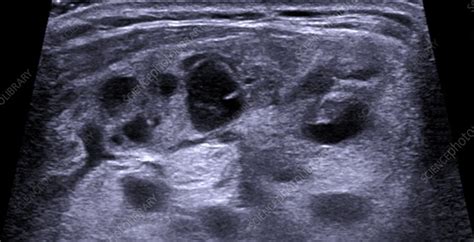 Multinodular Goitre Thyroid Ultrasound Stock Image C0131034
