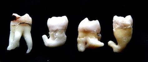 Wisdomteeth Wisdom Teeth Roots Dental Surgery Dental Implants