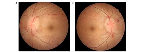 Cryptococcal Meningitis Initially Presenting With Eye Symptoms In An