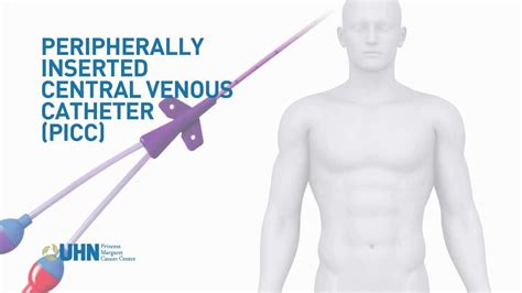 Learn About The Peripherally Inserted Central Venous Catheter Picc