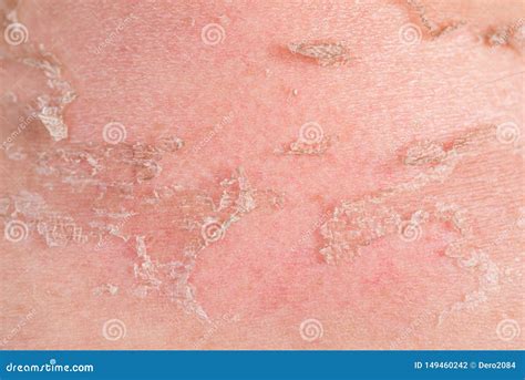 Sunburns Of Body Closeup Skin Damaged By Sun Peeling Body Care Theme