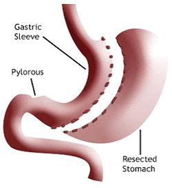 Gastric Sleeve Surgery Abroad Affordable Efficient Weight Loss Solution