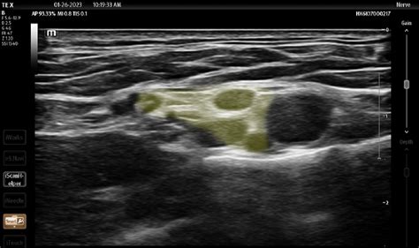 Ultrasound Image Of Supraclavicular Brachial Plexus Highlighted In